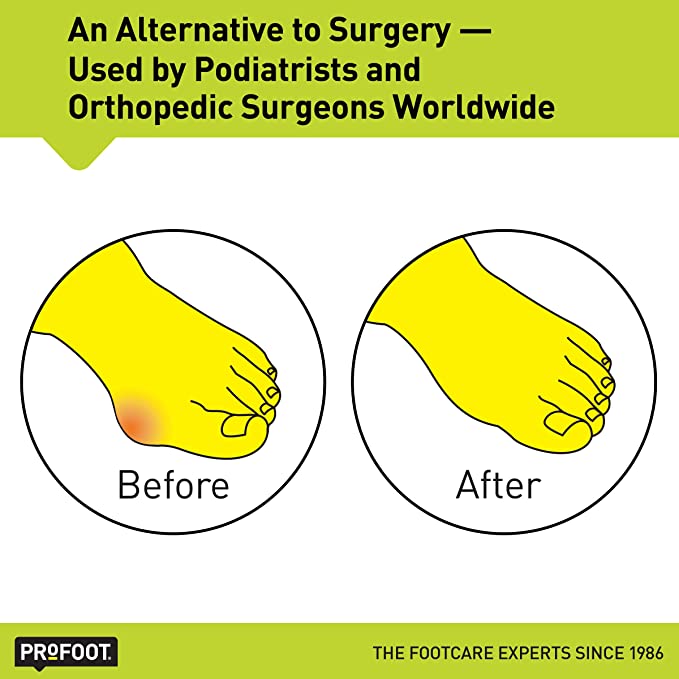 مصحح ومعالج بروز القدم وإعادة تنظيم الأوتار وإعادتها لوضعها الطبيعي